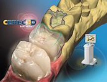 CEREC 3D齿雕的临床优点：